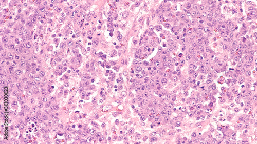 Lymph node biopsy showing an anaplastic lymphoma, a type of non Hodgkin lymphoma, a malignancy of lymphocytes. 