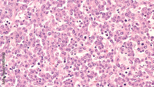 Lymph node biopsy showing an anaplastic lymphoma, a type of non Hodgkin lymphoma, a malignancy of lymphocytes.  photo