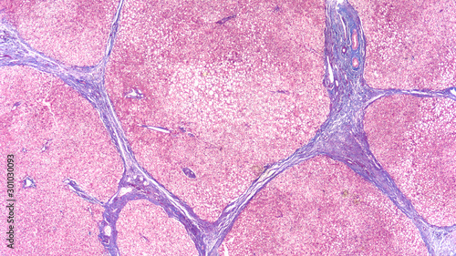 Photomicrograph of liver biopsy in a patient with cirrhosis, showing bridging septal fibrosis and regenerative nodules.  Stained with trichrome to highlight fibrosis  (blue). photo