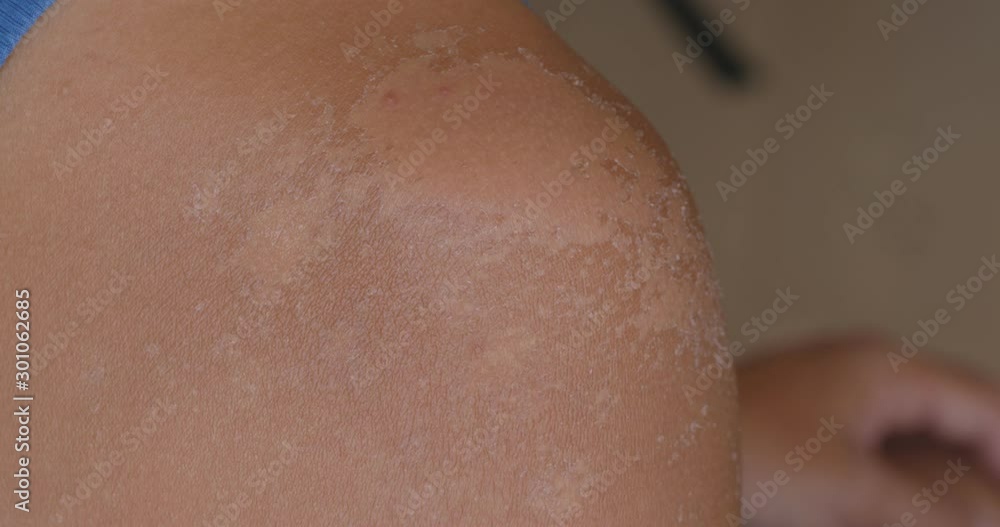 Sunburned skin, peeling skin from a sunburn Sunburned skin, peeling skin from a sunburn