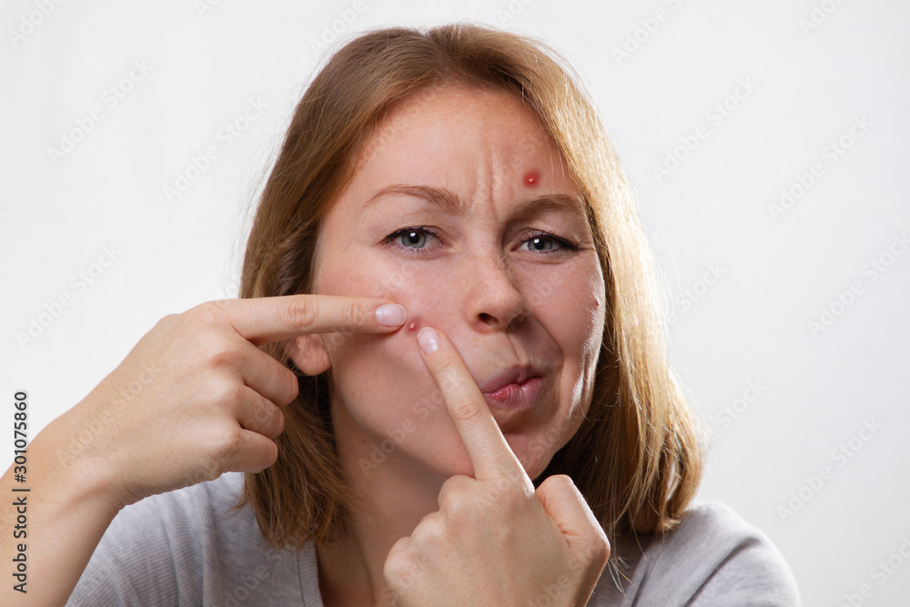 Medicine and cosmetology, acne. Portrait of a young blonde woman with pimples on her face, squeezes out an abscess with her fingers. White background Medicine and cosmetology, acne. Portrait of a young blonde woman with pimples on her face, squeezes out an abscess with her fingers. White background