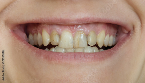 Smile with ugly crooked yellow teeth with fillings. 