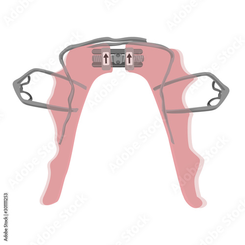 Palatal expander for the lower jaw to treat children with narrow jaws and vertical face growth. Flat vector illustration isolated on white.