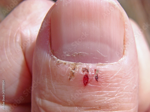 Tableau sur toile Cracked hangnails 2