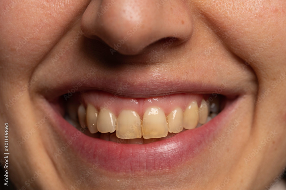 Person with yellow teeth close up - obrazy, fototapety, plakaty 