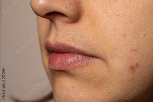 Young woman with rash on cheek close up