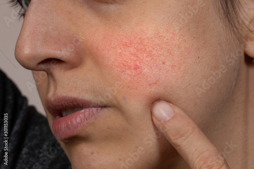 Woman pointing at red spot, rosacea on face close up