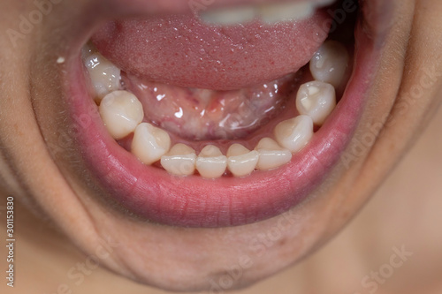 Lower teeth row close up