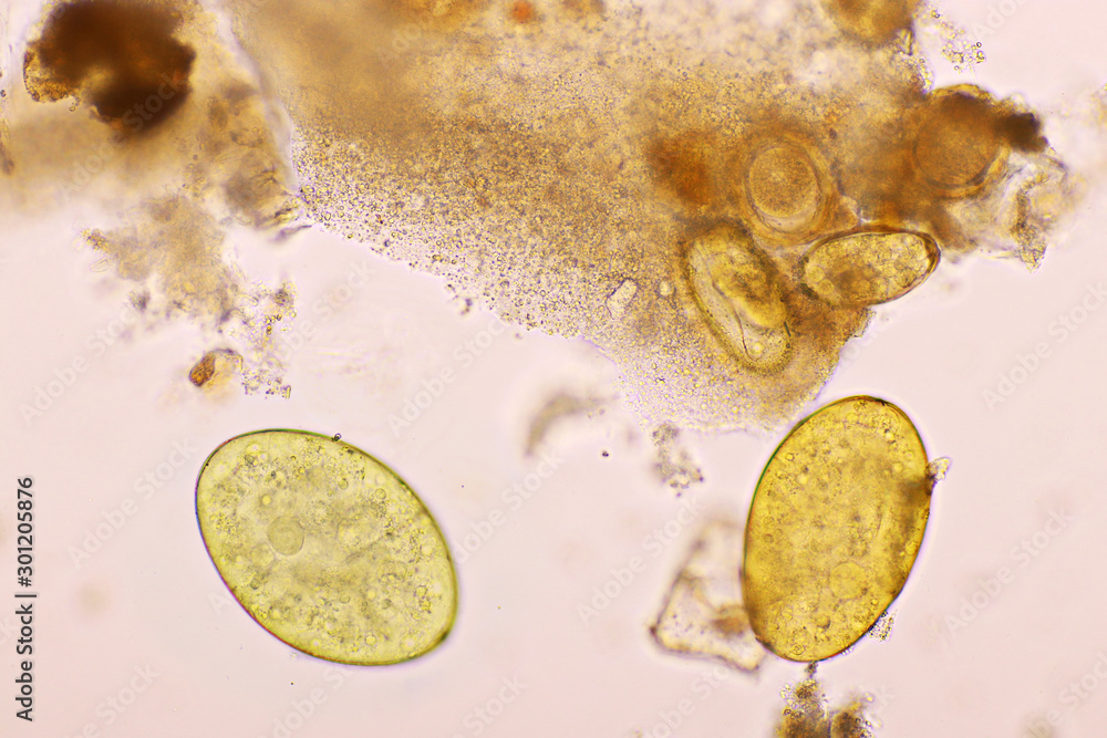 Eggs of intestinal fluke in human stool, analyze by microscope