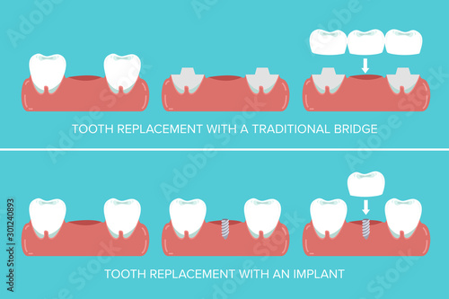Dental implants versus fixed bridges