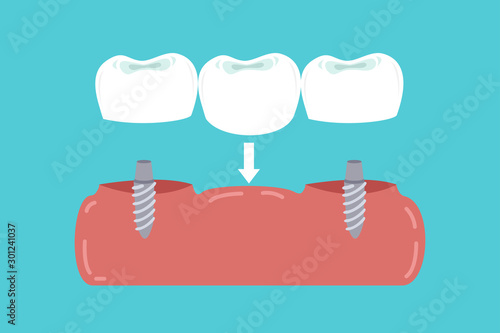 implants in gums supported dental bridge