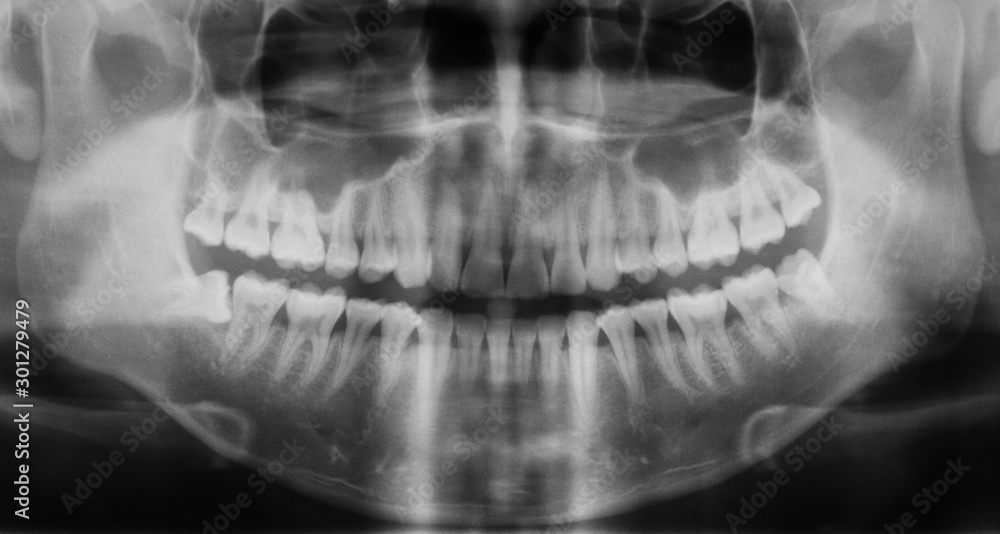 Panoramic dental x-ray image, Dental caries and treatment Stock Photo