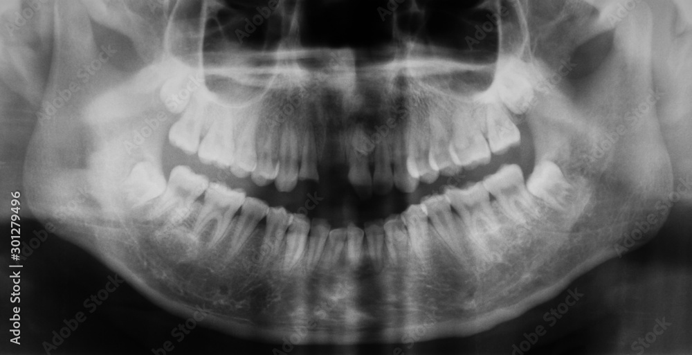 Panoramic dental x-ray image, The upper teeth are broken and loose. Panoramic dental x-ray image, The upper teeth are broken and loose.