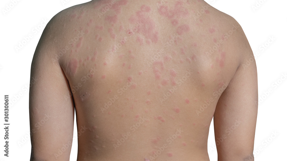 Urticaria or hives on child back with clipping paths Urticaria or hives on child back with clipping paths