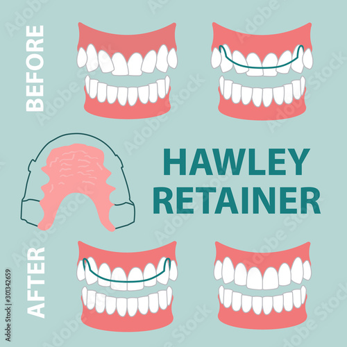 vector illustration.hawley retainer before and after