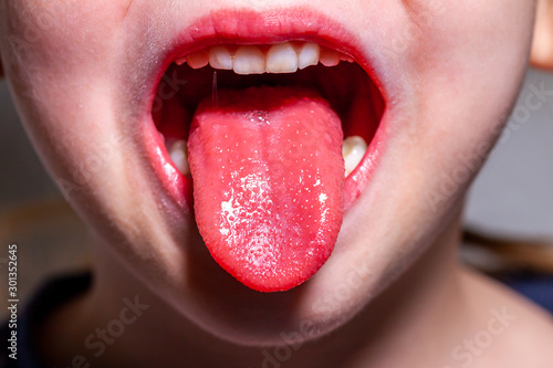 Photo Tongue of a child with scarlet fever - strawberry tongue