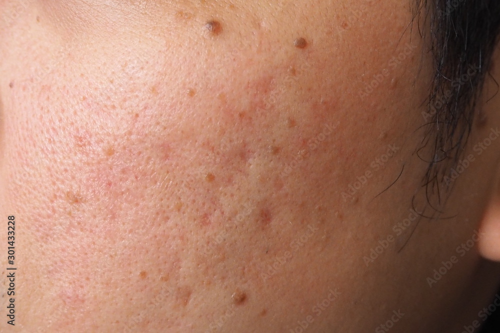 Closeup of acne and moles on the face of a young Asian man Health medical beauty aesthetics concept Closeup of acne and moles on the face of a young Asian man Health medical beauty aesthetics concept
