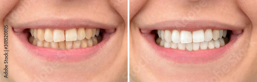 Teeth of a woman before and after correction and whitening photo