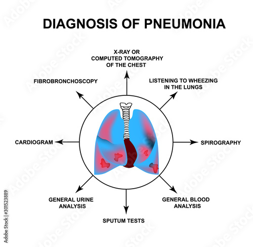 Diagnosis of pneumonia. Human respiratory organs. World Pneumonia Day. The anatomical structure of inflamed lungs. Infographics. Vector illustration on isolated background.