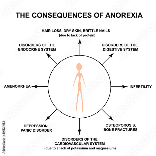 The consequences of anorexia. Slim physique with anorexia. Infographics. Vector illustration on isolated background.