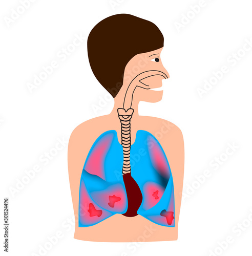 Lungs affected by tuberculosis, bronchitis. Human respiratory system. World Pneumonia Day. The anatomical structure of inflamed lungs. Infographics. Vector illustration on isolated background.