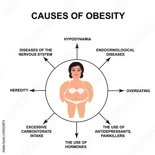 Causes of Obesity International Day Against Obesity. Infographics. Vector illustration on isolated background.