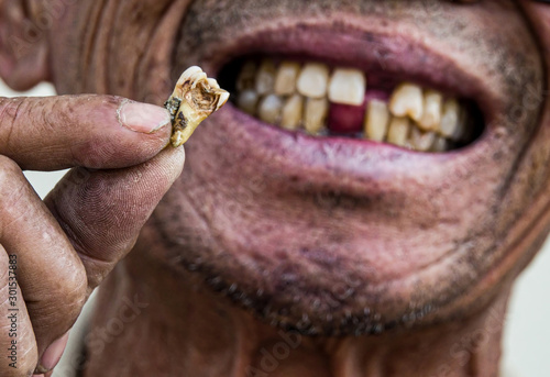 hand showing broken teeth,close up broken teeth detail. © SAKCHAI