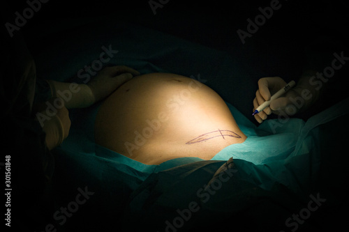 Vorbereitung zum Kaiserschnitt photo
