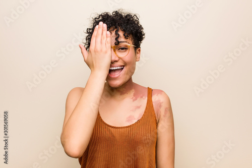Young african american woman with skin birth mark having fun covering half of face with palm.
