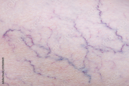 Enlarged varicose veins on a leg of a senior woman, phlebology concept photo