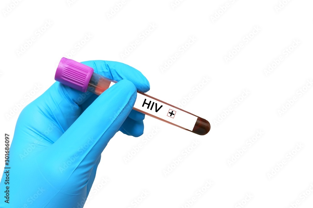 Obraz premium HIV positive Blood tests isolation on white background