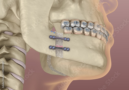 Billede på lærred Mandibular Advancement surgery
