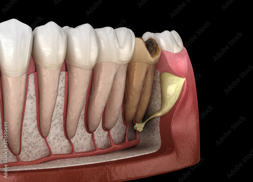 Periostitis tooth Lump on Gum Above Tooth. Medically accurate dental
