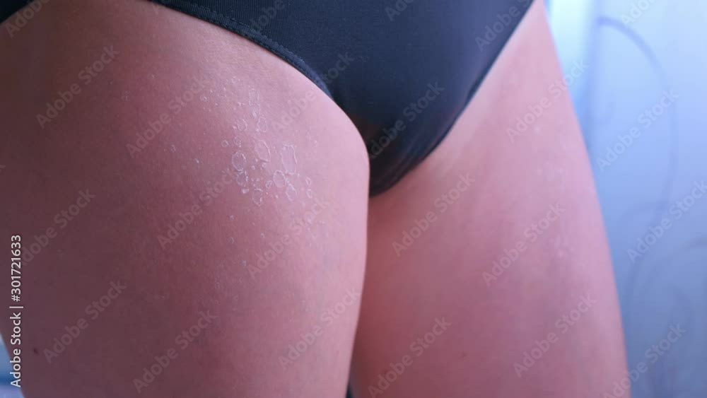 Woman in panties with peeling skin from UV sunburn on legs, closeup view. UV exposure causes sun burns and skin irritations. Burnt skin after exposing too much to the sun.