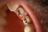 tooth restoration on the pin / dentistry macro, tooth, gum, dental treatment