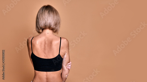Girl with vitiligo disease covers her face with hands, closeup portrait on beige background