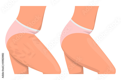 Cellulite on the hips vector isolated. Before and after, female