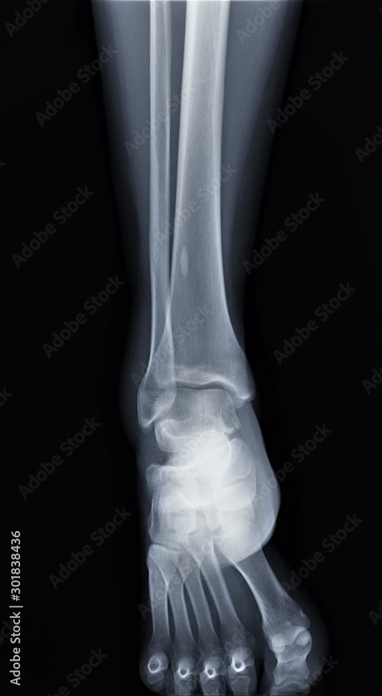 normal radiography of the ankle joint in direct projection, traumatology and orthopedics rheumatology normal radiography of the ankle joint in direct projection, traumatology and orthopedics rheumatology