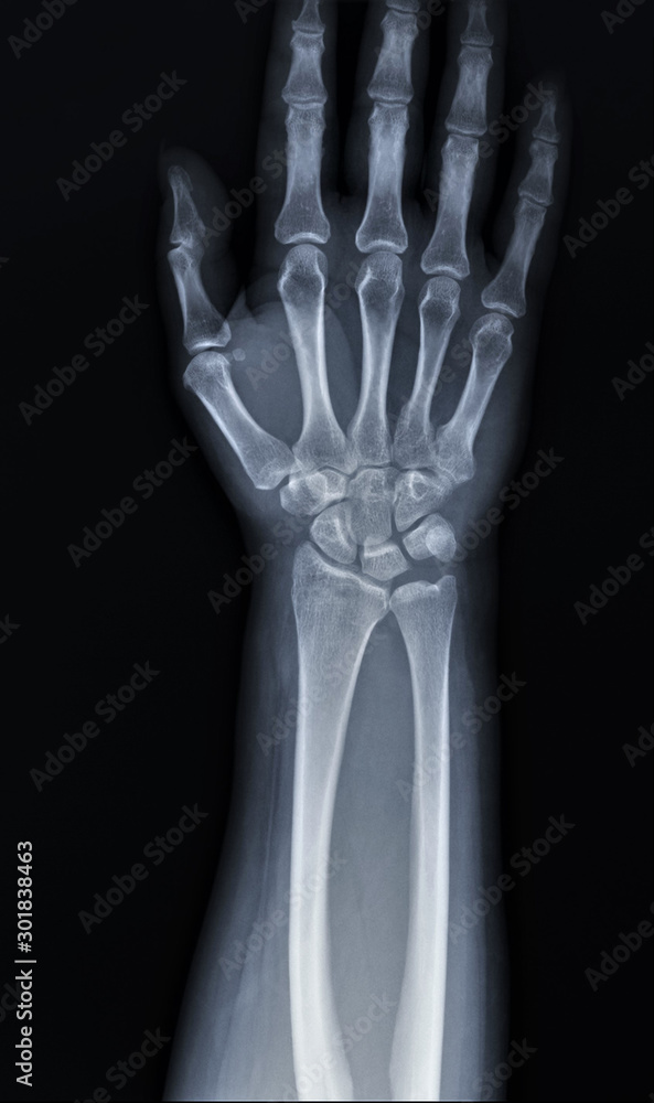 normal x-ray of the hand bones and fingers,orthopedics, medical diagnostics, rheumatology normal x-ray of the hand bones and fingers,orthopedics, medical diagnostics, rheumatology