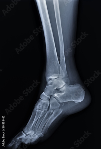 normal radiography of the ankle joint in lateral projection, traumatology and orthopedics, rheumatology © Anton