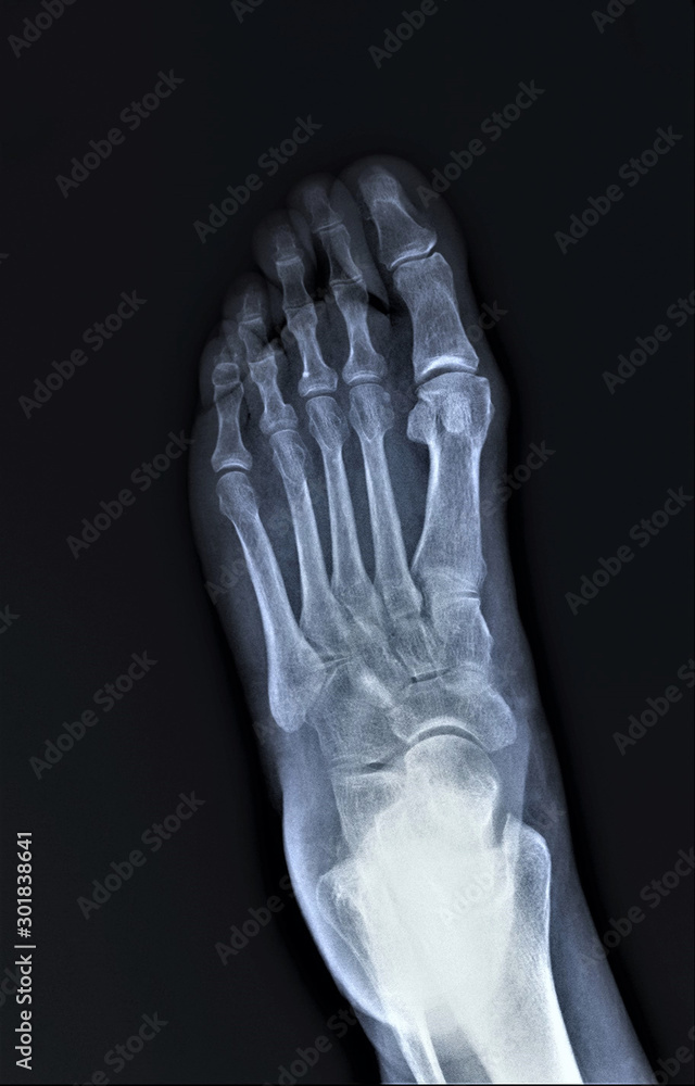 normal radiography of the foot, medical diagnostics, traumatology and orthopedics, rheumatology normal radiography of the foot, medical diagnostics, traumatology and orthopedics, rheumatology