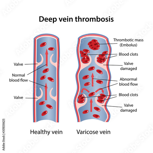 Deep vein thrombosis of legs. Image of healthy and diseased veins. Vector illustration in flat style isolated on white background