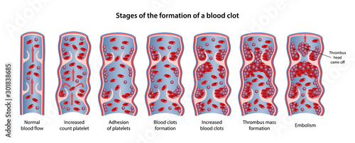 Stages of the formation of blood clot: increased count platelet, adhesion of platelets, formation of blood clots, then thrombus mass, embolism. Vector illustration in flat style with main description.