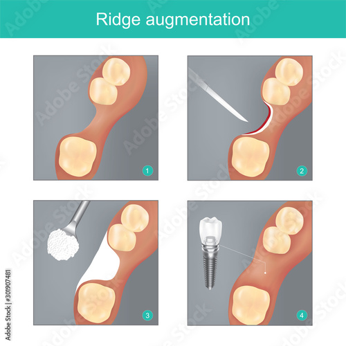 Ridge augmentation. The method dental used materials synthetic or human bone for Replace the Jawbone In missing, and to Prepare dental implant work to next step..