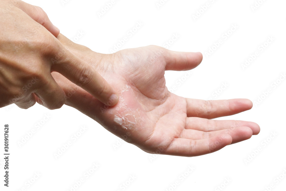 Hand skin peeling isolated on white background Hand skin peeling isolated on white background