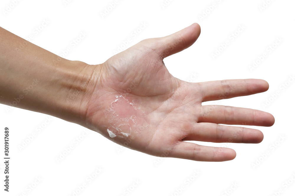 Hand skin peeling isolated on white background Hand skin peeling isolated on white background