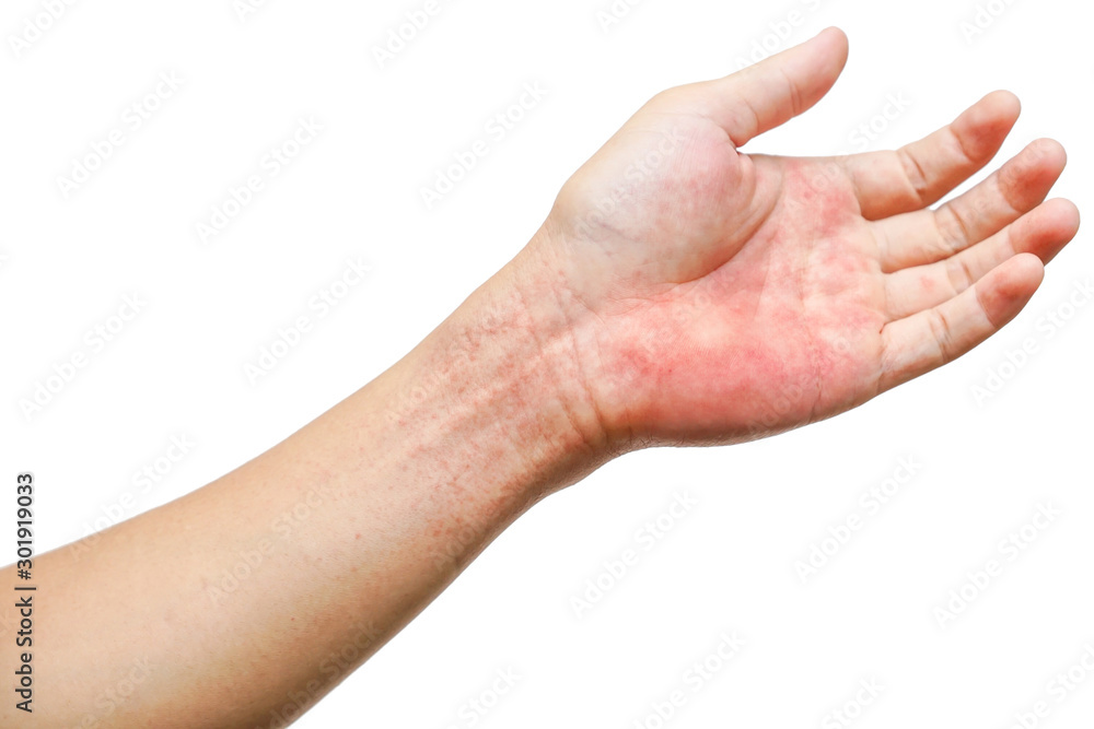 Red rash on wrist and hand isolated on white background / Rashes  on skin caused by virus - obrazy, fototapety, plakaty 