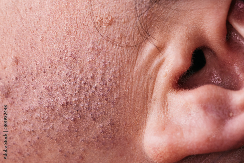 Fototapeta premium Skin face after removing hair