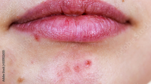 Female face with acne skin problem