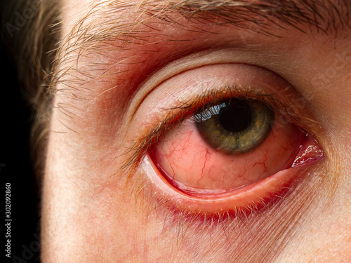 conjunctivitis, conjunctival inflammation, red eyes, infection and inflammation, close up eye photo